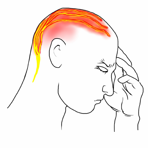 Cervicogenic Headache: Symptoms, Causes and Treatment