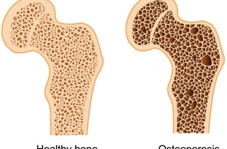 The Role of Genetics in Osteoporosis: Are You at Risk?
