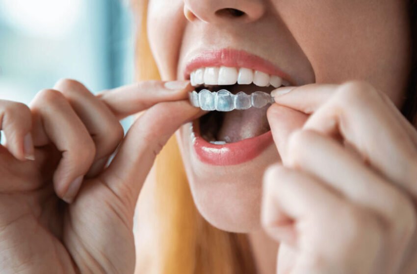  Know All About Aligners: Clear Solution to Straight Teeth