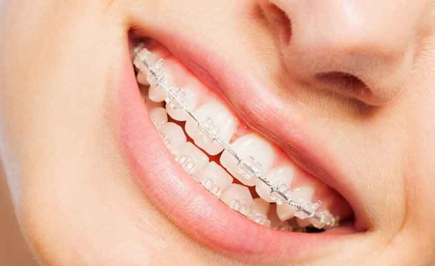 6 Everyday Habits That Affect Your Results With Clear Braces in Las Vegas